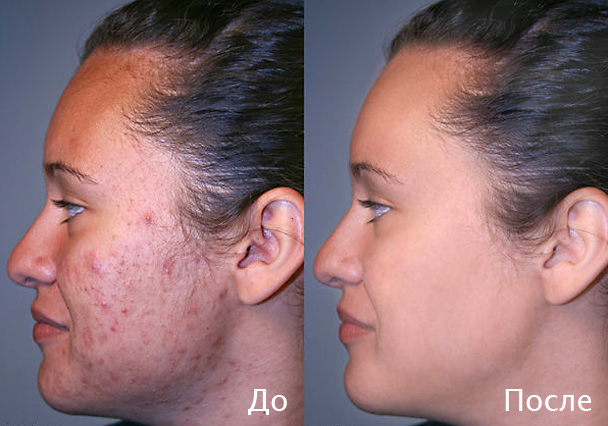 Интераура - Лечение и профилактика_ Акне (мужская _0.jpg